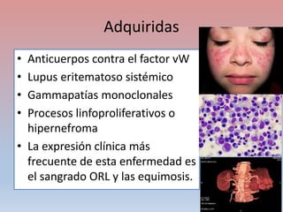 Adquiridas
• Anticuerpos contra el factor vW
• Lupus eritematoso sistémico
• Gammapatías monoclonales
• Procesos linfoproliferativos o
hipernefroma
• La expresión clínica más
frecuente de esta enfermedad es
el sangrado ORL y las equimosis.
 