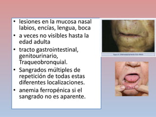 • lesiones en la mucosa nasal
labios, encías, lengua, boca
• a veces no visibles hasta la
edad adulta
• tracto gastrointestinal,
genitourinario,
Traqueobronquial.
• Sangrados múltiples de
repetición de todas estas
diferentes localizaciones.
• anemia ferropénica si el
sangrado no es aparente.
 