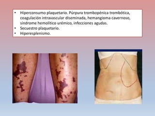 • Hiperconsumo plaquetario. Púrpura trombopénica trombótica,
coagulación intravascular diseminada, hemangioma cavernoso,
síndrome hemolítico urémico, infecciones agudas.
• Secuestro plaquetario.
• Hiperesplenismo.
 