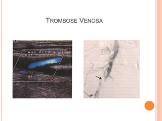 TROMBOSE VENOSA
 