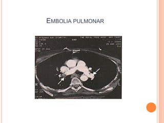 EMBOLIA PULMONAR
 