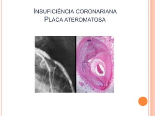 INSUFICIÊNCIA CORONARIANA
   PLACA ATEROMATOSA
 