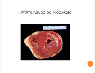 INFARTO AGUDO DO MIOCÁRDIO
 