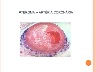 ATEROMA – ARTÉRIA CORONÁRIA
 