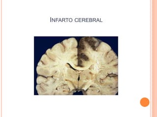 INFARTO CEREBRAL
 