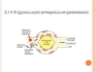 C I V D (COAGULAÇÃO INTRAVASCULAR DISSEMINADA)
 