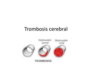 Trombosis cerebral
 