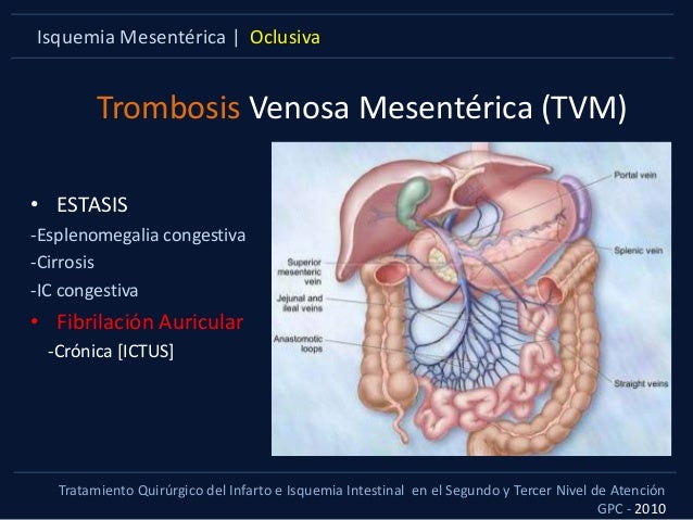Angiodisplasia del colon