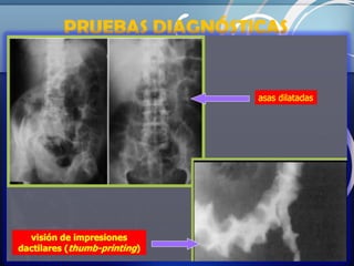 PRUEBAS DIAGNÓSTICAS
COMPLEMENTARIAS

Radiología simple: Es normal inicialmente.
• Edema de pared, distensión de asas, y gas intramural o libre
en peritoneo.
• Impresiones dactilares (thumb-printing) en el intestino
delgado o el colon = infarto. M > 70%
ECO doppler: Puede detectar oclusiones en el origen de la
AMS, del tronco celiaco o de la porta-mesentérica.

 