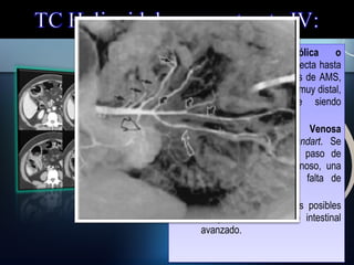 – 1.
Oclusión
embólica
o
trombótica Arterial: detecta hasta
el 78% de las oclusiones de AMS,
aunque si la oclusión es muy distal,
la arteriografía sigue siendo
superior.
– 2.
Trombosis
Venosa
Mesentérica: Gold standart. Se
aprecia un retraso del paso de
contraste al sistema venoso, una
pared engrosada y la falta de
opacificación de la porta.
– 3. IMNO: descarta otros posibles
Dx y detecta el infarto intestinal
avanzado.

 