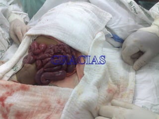 Trombosis mesenterica