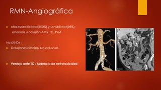 RMN-Angiográfica
 Alta especificidad(100%) y sensiblidad(98%):
estenosis u oclusión AMS ,TC, TVM
No útil Dx :
 Oclusiones distales/ No oclusivas
 Ventaja ante TC : Ausencia de nefrotoxicidad
 