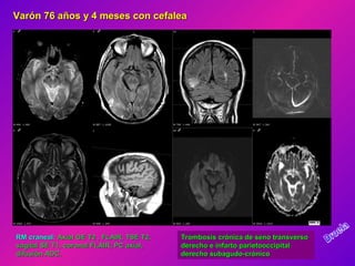 Varón 76 años y 4 meses con cefaleaVarón 76 años y 4 meses con cefalea
RM craneal:RM craneal: Axial GE T2 , FLAIR, TSE T2,Axial GE T2 , FLAIR, TSE T2,
sagital SE T1, coronal FLAIR, PC axial,sagital SE T1, coronal FLAIR, PC axial,
difusión ADC.difusión ADC.
Trombosis crónica de seno transversoTrombosis crónica de seno transverso
derecho e infarto parietooccipitalderecho e infarto parietooccipital
derecho subagudo-crónicoderecho subagudo-crónico
 