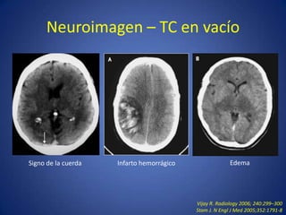 Trombosis Senos Venosos Cerebrales PPTX trombosis-senos-venosos-cerebrales-pptx
