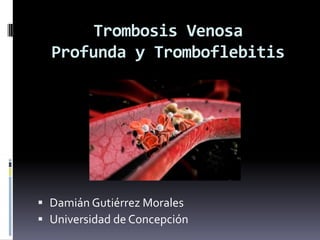 Trombosis Venosa
  Profunda y Tromboflebitis




 Damián Gutiérrez Morales
 Universidad de Concepción
 