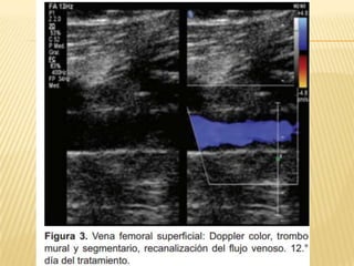 Trombosis venosa profunda