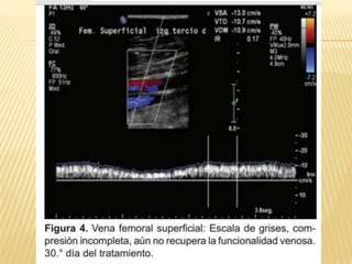 Trombosis venosa profunda