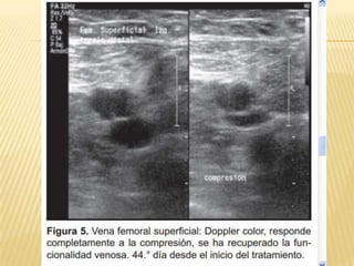 Trombosis venosa profunda