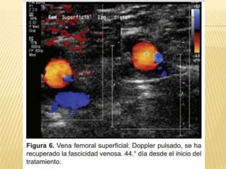 Trombosis venosa profunda
