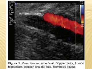 Trombosis venosa profunda