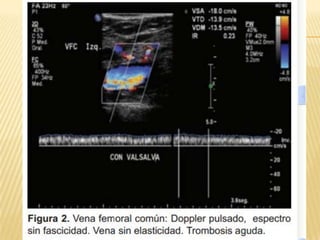 Trombosis venosa profunda