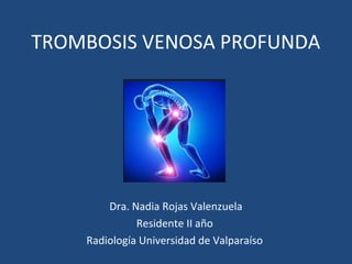 TROMBOSIS VENOSA PROFUNDA
Dra. Nadia Rojas Valenzuela
Residente II año
Radiología Universidad de Valparaíso
 
