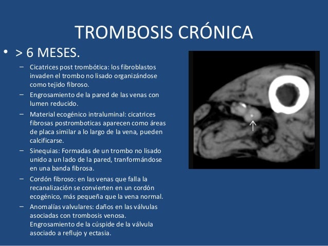 Como curar la hemorroide de por varikoza