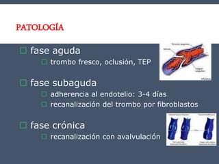 PATOLOGÍA
 fase aguda
 trombo fresco, oclusión, TEP
 fase subaguda
 adherencia al endotelio: 3-4 días
 recanalización del trombo por fibroblastos
 fase crónica
 recanalización con avalvulación
 