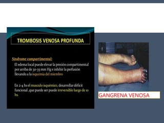 GANGRENA VENOSA
 