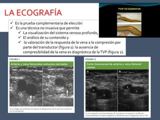 LA ECOGRAFÍA
 Es la prueba complementaria de elección
 Es una técnica no invasiva que permite
 La visualización del sistema venoso profundo,
 El análisis de su contenido y
 la valoración de la respuesta de la vena a la compresión por
parte del transductor (figura 1): la ausencia de
compresibilidad de la vena es diagnóstica de laTVP (figura 2).
 