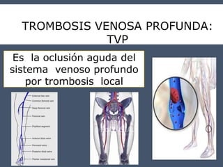 TROMBOSIS VENOSA PROFUNDA:
TVP
Es la oclusión aguda del
sistema venoso profundo
por trombosis local
 