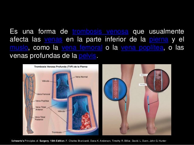 El envolvimiento para los pies a varikoze