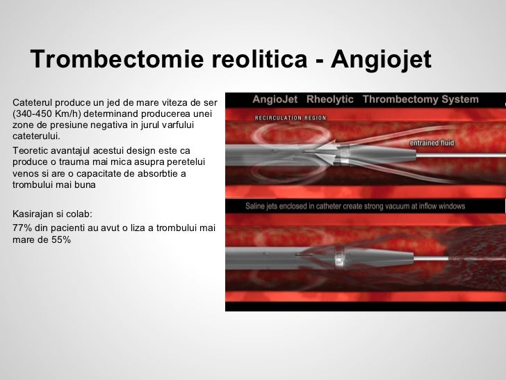 Tromboza venoasa profunda - atitudine chirurgicala