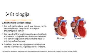 Etiologija
2. Neishemijska kardiomiopatija
• Kod ovih pacijenata se tromb leve komore razvija
kao komplikacija zbog zastoja krvi u jako
proširenoj levoj komori
• Kod hipertrofične kardiomiopatije, posebno kada
je povezana sa pogoršanom sistolnom funkcijom
leve komore i apikalnim aneurizmama može se
javiti tromb leve komore
• Tromboza leve komore je opisana i u bolestima
kao što su amiloidoza, hipereozinofilni sindrom…
Left ventricular thrombosis: new perspectives on an old problem, Mauro Massussi, Andrea Scotti, Gregory Y.H. Lip and Riccardo Proietti
 