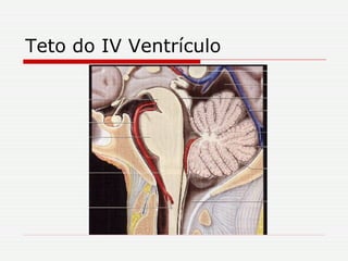 Teto do IV Ventrículo 