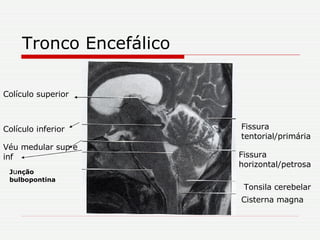 Tronco Encefálico Cisterna magna Tonsila cerebelar Fissura horizontal/petrosa Fissura tentorial/primária J u nção bulbopontina Véu medular sup e inf Colículo inferior Colículo superior 