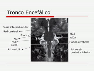 Tronco Encefálico NC5 AICA Flóculo cerebelar Art cereb posterior inferior Art vert dir  Bulbo  NC8 NC7 Ponte Ped cerebral Fossa interpeduncular 