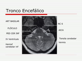 Tronco Encefálico ART BASILAR FLÓCULO PED CER INF IV Ventrículo Hemisf cerebelar inf Tonsila cerebelar Vermis AICA NC 6 