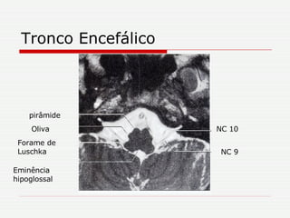 Tronco Encefálico pirâmide Oliva  Forame de Luschka Eminência hipoglossal NC 10 NC 9 