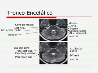 Tronco Encefálico Coliculo facial Nucl denteado vermis floculo NC5 Ponte Cavo de Meckel Cist APC Ped cereb médio Nódulo Trato cort-esp IV Vent ponte Fasc long medial Ped cereb sup cist pre-pont vermis Art Basilar 