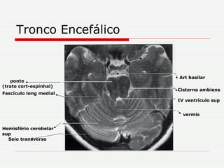 Tronco Encefálico Cisterna ambiens IV ventrículo sup vermis Art basilar Seio transverso Hemisfério cerebelar sup ponte Fascículo long medial (trato cort-espinhal) 