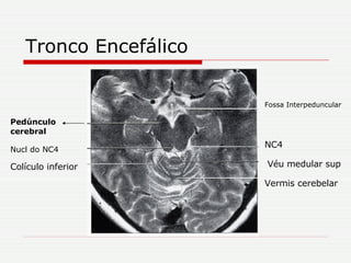 Tronco Encefálico Véu medular sup Vermis cerebelar NC4 Fossa Interpeduncular Pedúnculo cerebral Nucl do NC4 Colículo inferior 