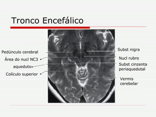 Tronco Encefálico Subst nigra Nucl rubro Subst cinzenta periaquedutal aqueduto Vermis cerebelar Pedúnculo cerebral Área do nucl NC3 Colículo superior 