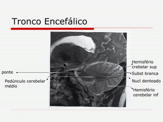 Tronco Encefálico Hemisfério cerebelar inf Nucl denteado Subst branca Hemisfério crebelar sup Pedúnculo cerebelar médio ponte 