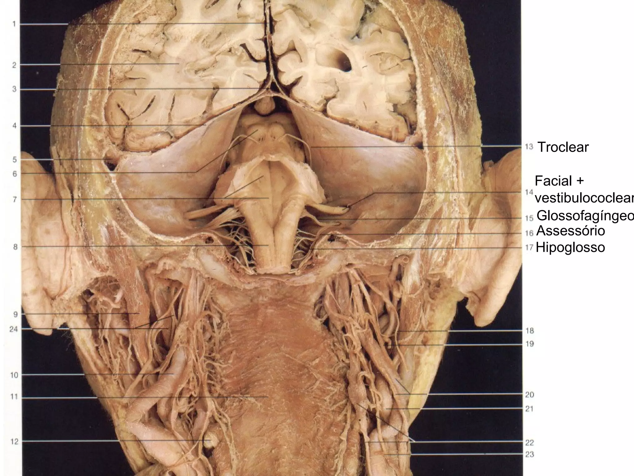 Facial +
vestibulococlear
Glossofagíngeo
Assessório
Hipoglosso
Troclear
 