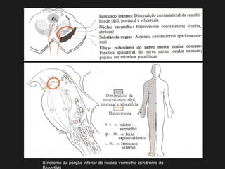 Síndrome da porção inferior do núcleo vermelho (síndrome de
 