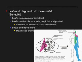  Lesões do tegmento do mesencéfalo
(Benedikt)

Lesão do óculomotor ipsilateral

Lesão dos lemniscos media, espinhal e trigeminal
 Anestesia da metade do corpo contralateral

Lesão do núcleo rubro
 Movimentos anormais contralateral
 