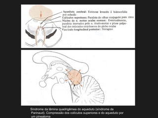 Síndrome da lâmina quadrigêmea do aqueduto (síndrome de
Parinaud). Compressão dos colículos superiores e do aqueduto por
um pinealoma
 