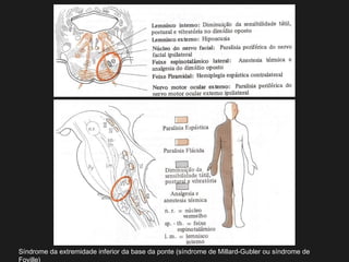 Síndrome da extremidade inferior da base da ponte (síndrome de Millard-Gubler ou síndrome de
Foville)
 