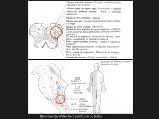 Síndrome de Wallenberg (síndrome do bulbo
 